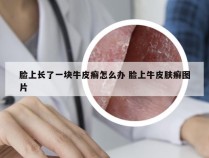 脸上长了一块牛皮癣怎么办 脸上牛皮肤癣图片