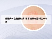 银屑病长在胳膊肘痒 银屑病只有胳膊上一小块
