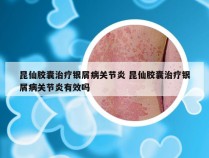 昆仙胶囊治疗银屑病关节炎 昆仙胶囊治疗银屑病关节炎有效吗