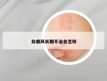 白癜风长期不治会怎样