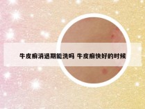 牛皮癣消退期能洗吗 牛皮癣快好的时候