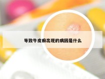 导致牛皮癣出现的病因是什么