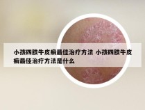 小孩四肢牛皮癣最佳治疗方法 小孩四肢牛皮癣最佳治疗方法是什么