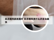 白点癫风前兆图片 白点癫风用什么药膏治最快