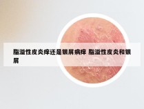 脂溢性皮炎痒还是银屑病痒 脂溢性皮炎和银屑