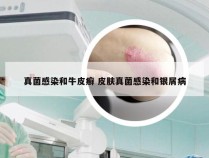 真菌感染和牛皮癣 皮肤真菌感染和银屑病
