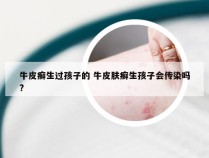 牛皮癣生过孩子的 牛皮肤癣生孩子会传染吗?