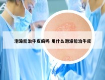 泡澡能治牛皮癣吗 用什么泡澡能治牛皮
