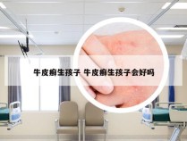 牛皮癣生孩子 牛皮癣生孩子会好吗