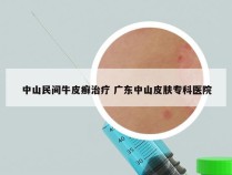 中山民间牛皮癣治疗 广东中山皮肤专科医院