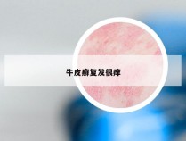 牛皮癣复发很痒