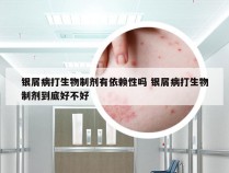 银屑病打生物制剂有依赖性吗 银屑病打生物制剂到底好不好