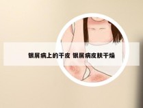 银屑病上的干皮 银屑病皮肤干燥