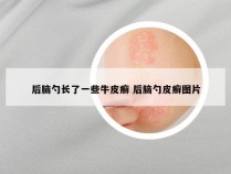 后脑勺长了一些牛皮癣 后脑勺皮癣图片