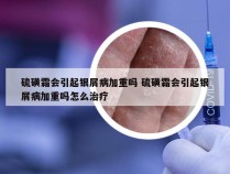 硫磺霜会引起银屑病加重吗 硫磺霜会引起银屑病加重吗怎么治疗