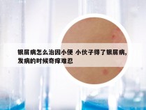 银屑病怎么治因小便 小伙子得了银屑病, 发病的时候奇痒难忍