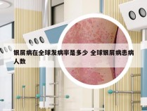 银屑病在全球发病率是多少 全球银屑病患病人数