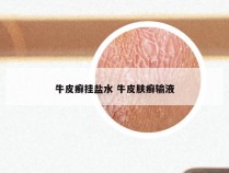 牛皮癣挂盐水 牛皮肤癣输液