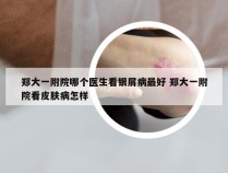 郑大一附院哪个医生看银屑病最好 郑大一附院看皮肤病怎样