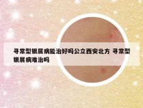 寻常型银屑病能治好吗公立西安北方 寻常型银屑病难治吗
