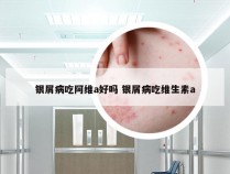 银屑病吃阿维a好吗 银屑病吃维生素a