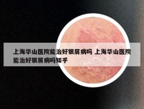 上海华山医院能治好银屑病吗 上海华山医院能治好银屑病吗知乎