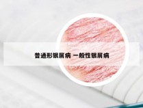 普通形银屑病 一般性银屑病
