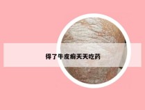 得了牛皮癣天天吃药