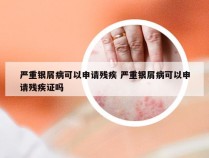 严重银屑病可以申请残疾 严重银屑病可以申请残疾证吗