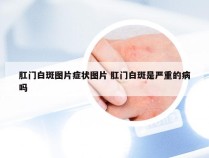 肛门白斑图片症状图片 肛门白斑是严重的病吗