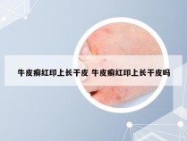 牛皮癣红印上长干皮 牛皮癣红印上长干皮吗