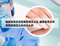 扁桃体发炎诱发银屑病怎么办 扁桃体发炎诱发银屑病怎么办吃什么药