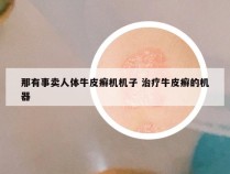 那有事卖人体牛皮癣机机子 治疗牛皮癣的机器