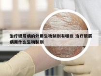 治疗银屑病的外用生物制剂有哪些 治疗银屑病用什么生物制剂