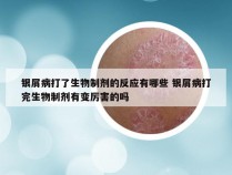 银屑病打了生物制剂的反应有哪些 银屑病打完生物制剂有变厉害的吗