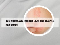 寻常型银屑病快好的图片 寻常型银屑病怎么治才能断根