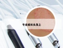牛皮癣长头发上