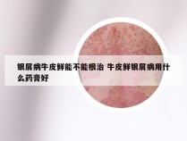 银屑病牛皮鲜能不能根治 牛皮鲜银屑病用什么药膏好