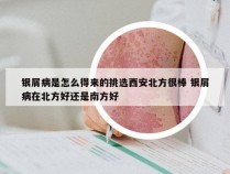 银屑病是怎么得来的挑选西安北方很棒 银屑病在北方好还是南方好