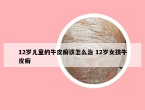12岁儿童的牛皮癣该怎么治 12岁女孩牛皮癣