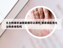 凡士林绵羊油银屑病可以用吗 银屑病能用凡士林身体乳吗