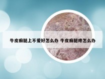 牛皮癣腿上不爱好怎么办 牛皮癣腿疼怎么办