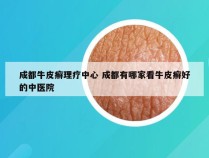 成都牛皮癣理疗中心 成都有哪家看牛皮癣好的中医院