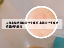 上海皮肤病医院治疗牛皮癣 上海治疗牛皮病癣最好的医院
