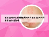 银屑病用什么药最好我妈妈有银屑病 妈妈有银屑病会遗传吗