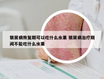 银屑病恢复期可以吃什么水果 银屑病治疗期间不能吃什么水果