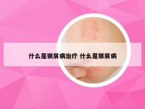 什么是银屑病治疗 什幺是银屑病