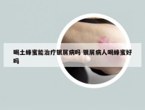 喝土蜂蜜能治疗银屑病吗 银屑病人喝蜂蜜好吗
