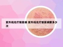 紫外线光疗银屑病 紫外线光疗银屑病要多少次