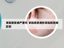 掌跖银屑病严重吗 掌跖银屑病和掌跖脓疱病区别